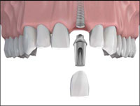 стоматологические имплантанты